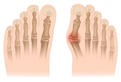 Hallux valgus