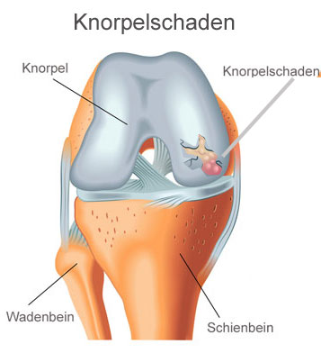 Knorpelschaden Knie